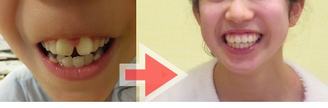 子供の歯科矯正